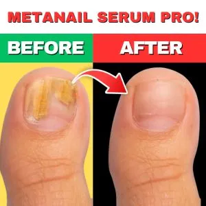 Metanail Serum Pro Nail Fungus Treatment